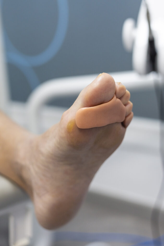 Siliconas podológicas en la clinica podológica en Dénia y Benidorm